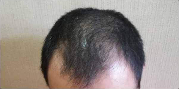 糖尿病でハゲる？